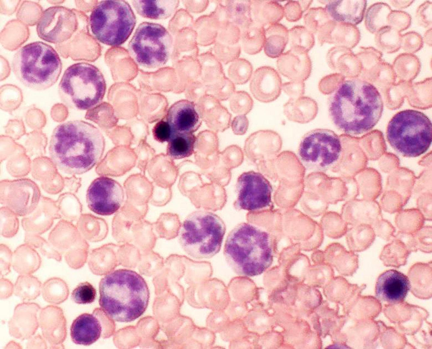 Treatment Resistant Leukemia