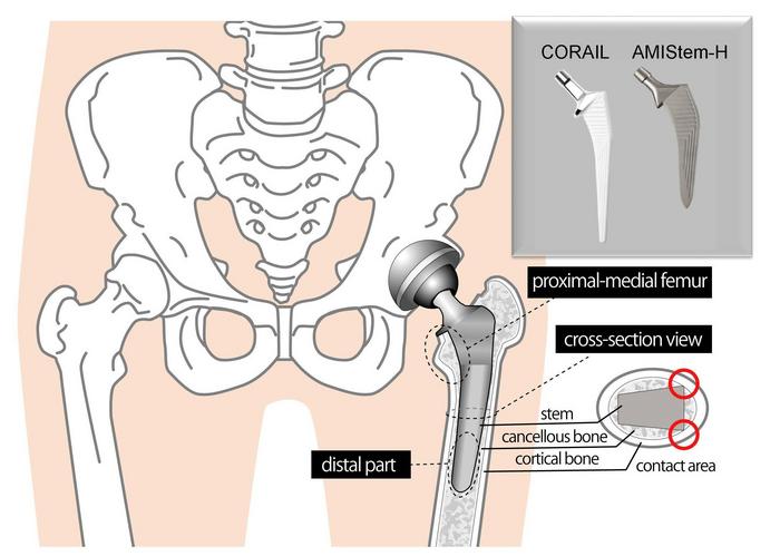 Artificial hip and two types of replacement stems
