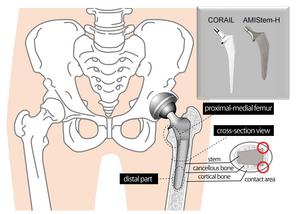 Artificial hip and two types of replacement stems