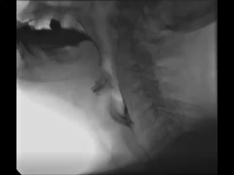 Modified Barium Swallow Study Animation