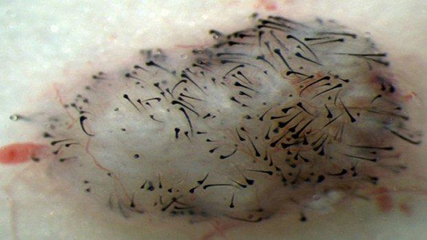 Hair Growth Using Stem Cells