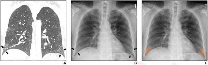 65-Year-Old Man With Biopsy-Proven Usual Interstitial Pneumonia