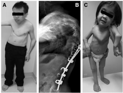 Pictures and X-ray of Patients with SEMD-JL1 and Ehlers-Danlos syndrome, Progeroid Type with B3GALT6