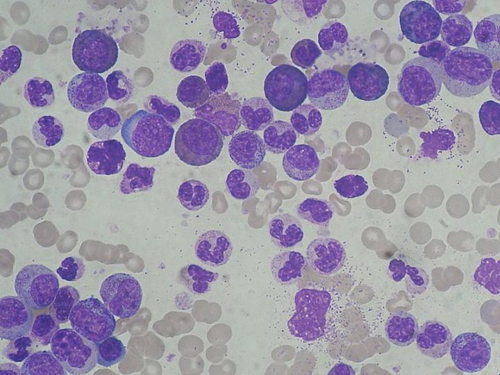 Optimal Treatment Plan for Chronic Myeloid Leukemia Suggested by Mathematical Modeling