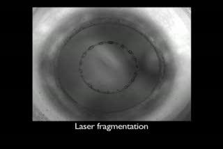 3-D Imaging Guides Femtosecond Laser in Cataracts Removal (10 of 10)