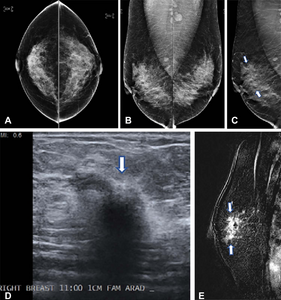 Huge Study Finds Tomosynthesis Better at Breast Cancer Detection