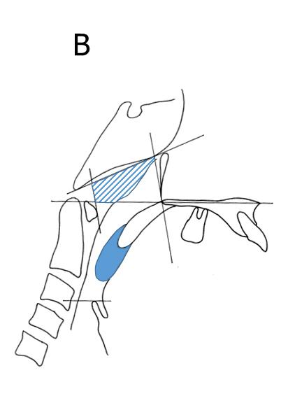 Figure 1.B Definitions of the adenoid (Ad) and tonsil (Tn).