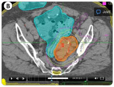 Imaging for Stereotactic Body Radiotherapy in Gynecologic Cancer (2 of 2)