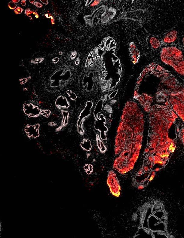 PI(3,4)P2: a New Marker for Tumor Progression