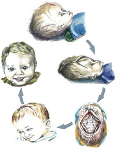 macrocephaly in infants