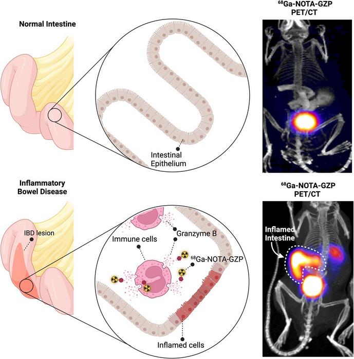 Granzyme B is detected and measured by the 68Ga-NOTA-GZP scan of  bowel with active inflammation.