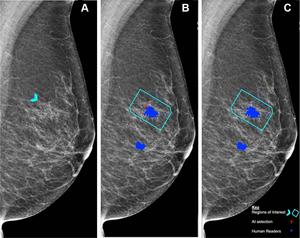 Left mediolateral oblique mammogram