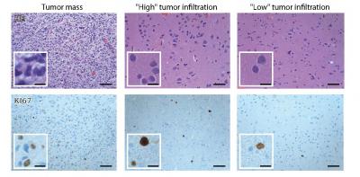 Chloride Imbalance May Explain Tumor-Linked Seizures (1 of 1)