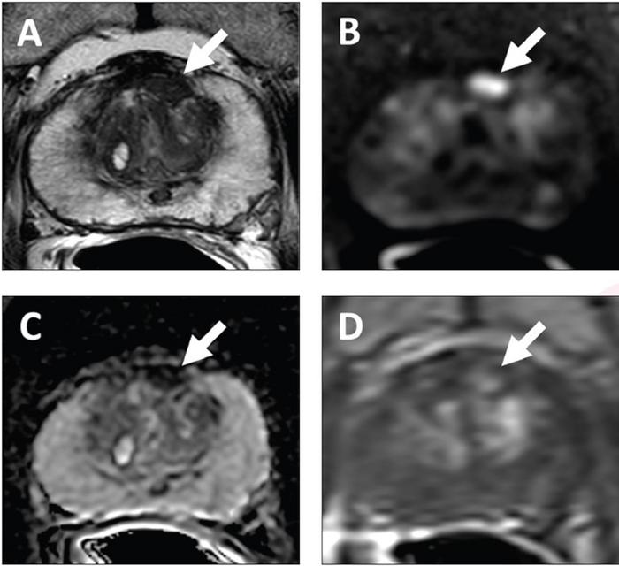 62-year-old with serum PSA level of 4.11 ng/mL. Prostate MRI shows lesion in left mid anterior transition zone.