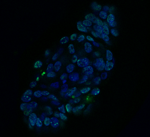 HNC organoid treated with cisplatin