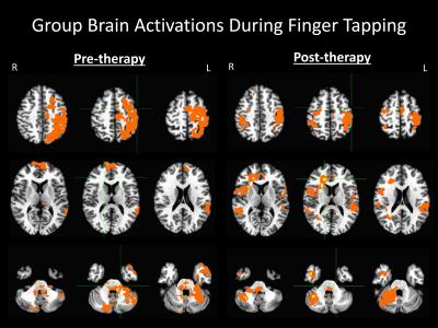 Brain Activation Patterns