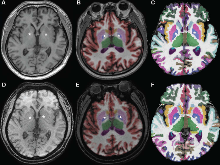 Axial MR Images at Basal Ganglia in 63-Year-Old Woman With Subjective Cognitive Impairment