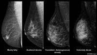 Breast Density Research and Cancer Prevention