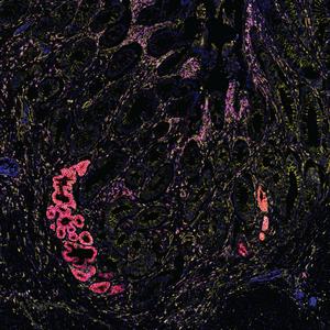Human Intestinal Tract in IBD (4)