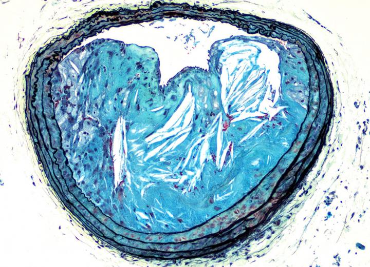 Cross Section of Advanced Atherosclerotic Lesion
