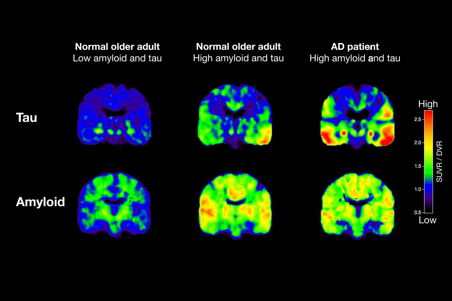 PET Scans [IMAGE] EurekAlert! Science News Releases