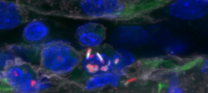 Section of a cerebral vessel in an infected animal model containing infected monocytes adhering to endothelial cells.