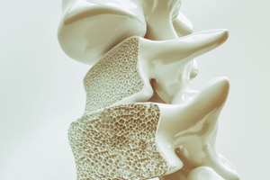 Osteoporosis in spine