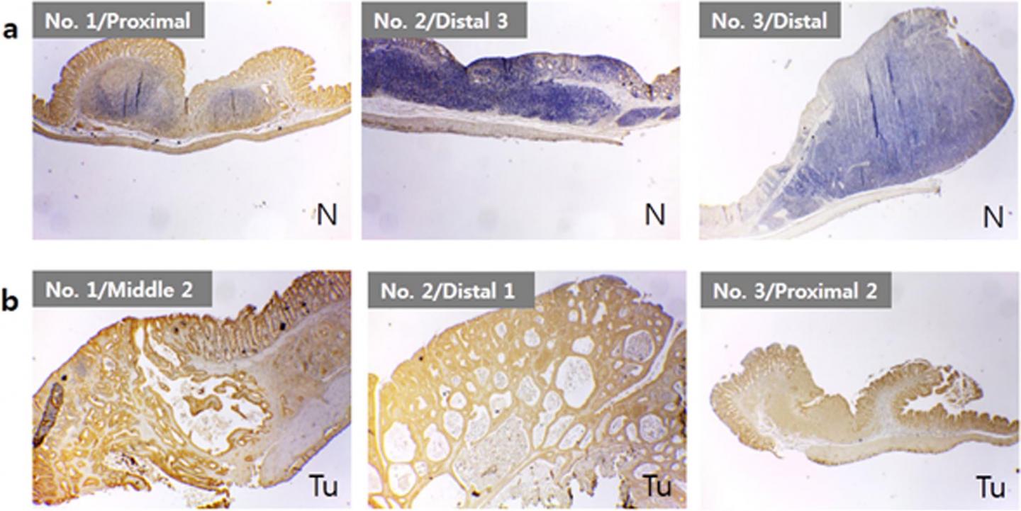 Figure 2 Beta Catenin Expression in Ployps