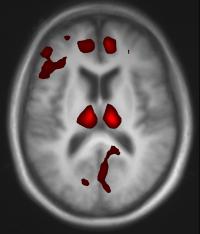 Perfusion MRI Scan