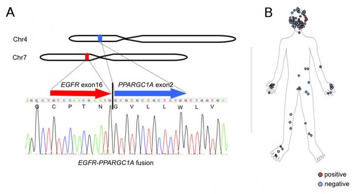 A431細胞株における新規EGFR-PPARGC1A融合遺伝子と、上皮扁平皮膚がん腫瘍サンプル102点の分布