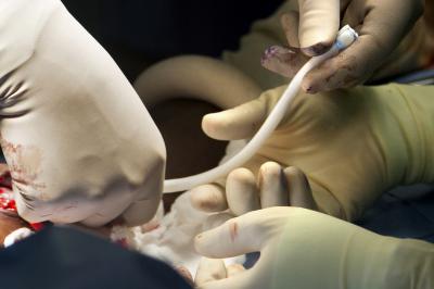 Investigational Bioengineered Blood Vessel