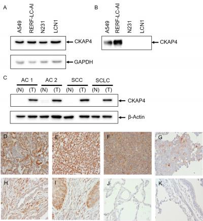 New Biomarker Identified for Early Diagnosis of Lung Cancer