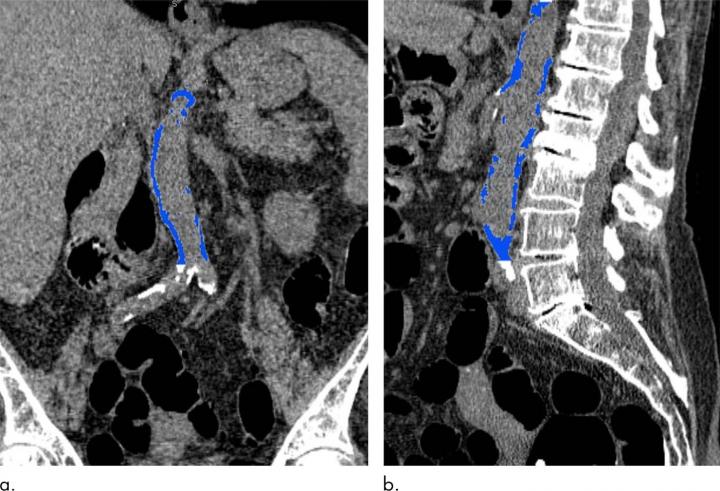 Images from CT Colonography Show Segmented Abdominal Aortic Calcification