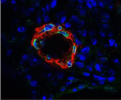 Keeping the Immune System in Check After Organ Transplants (1 of 5)