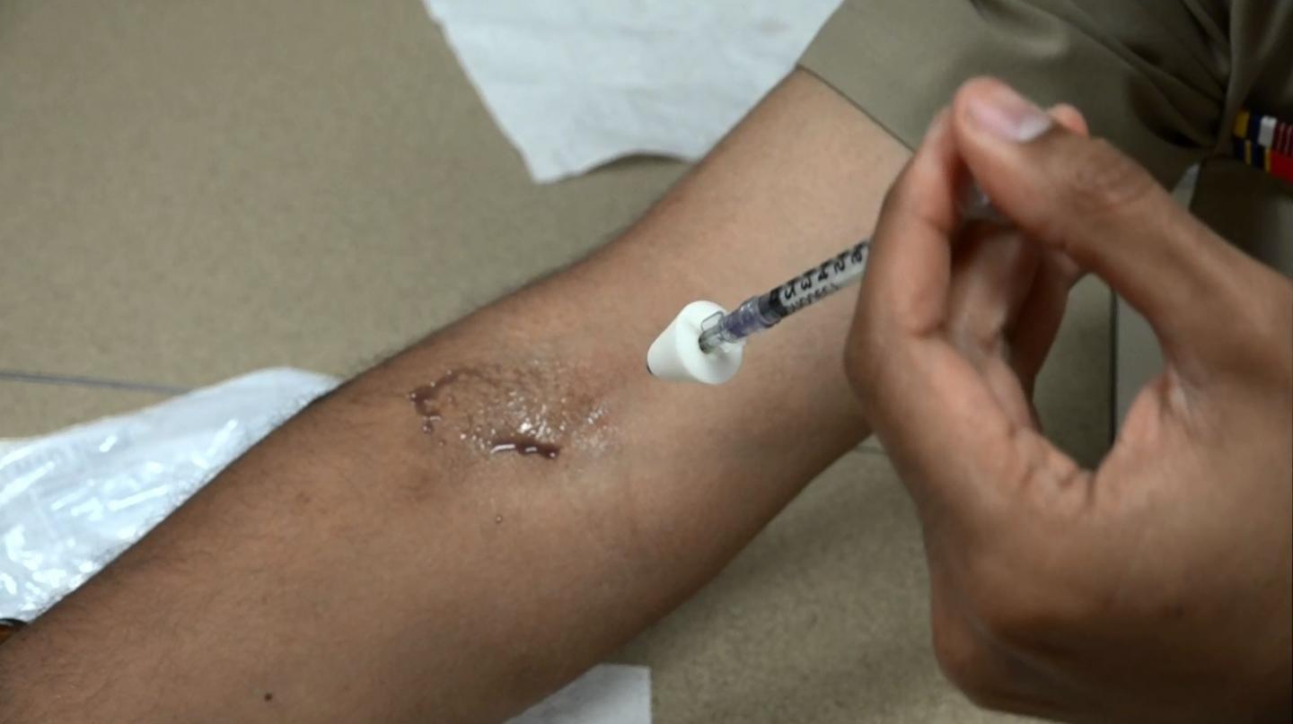 Scientist Demonstrates Application of an Experimental Eczema Therapy to the Inner Elbow