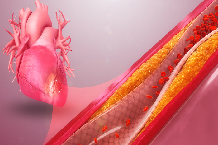 3D Still of Myocardial Ischemia.