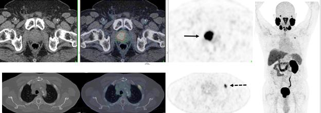 PSMA PET/CT accurately detects recurrent prostate cancer in 67-year-old man.