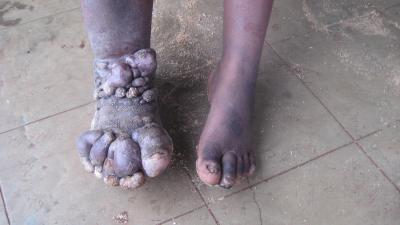 Podoconiosis