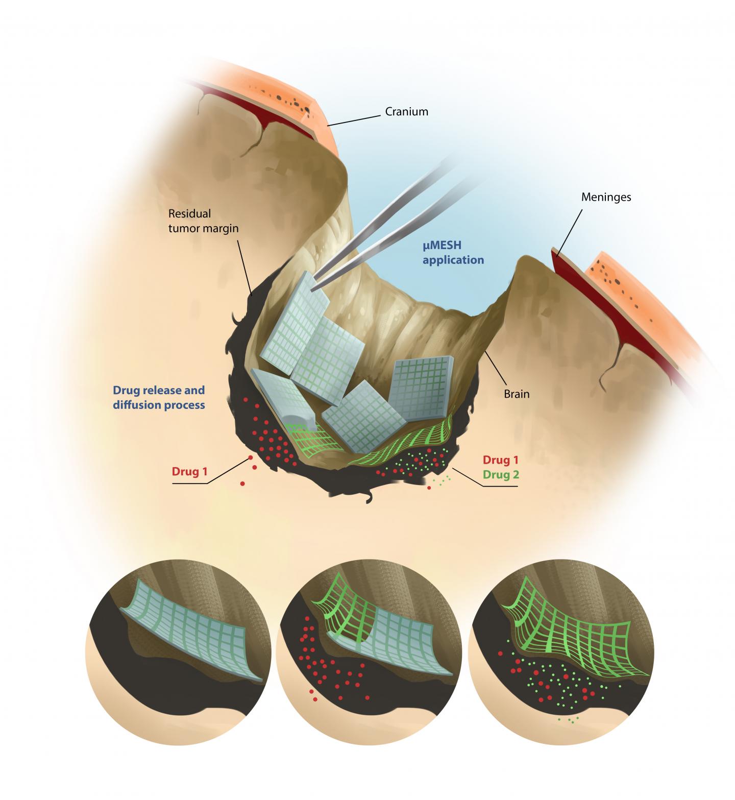 MicroMesh Application Procedure