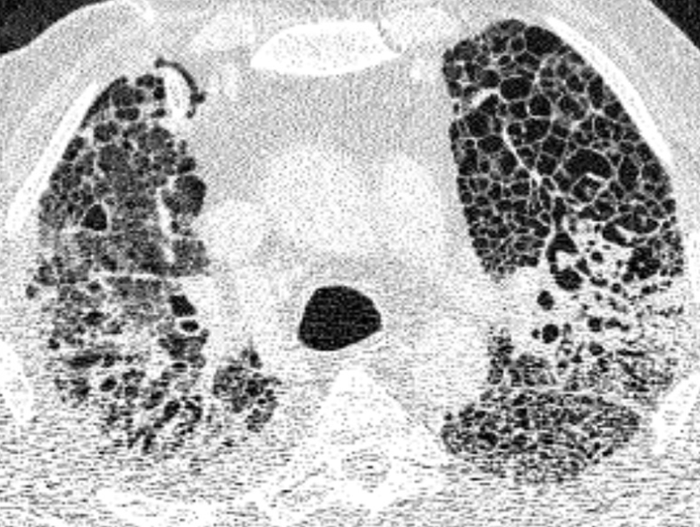 Chest CT of a patient with COVID-19-related respiratory failure