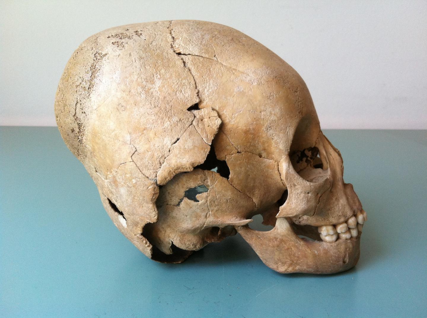 A Modified Skull