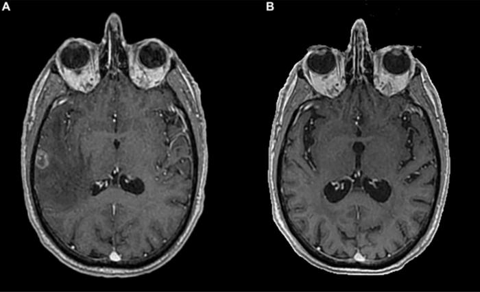 Complete and long-lasting response to immunotherapy in a stage IV non-small cell lung cancer with brain metastasis