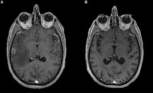 Complete and long-lasting response to immunotherapy in a stage IV non-small cell lung cancer with brain metastasis