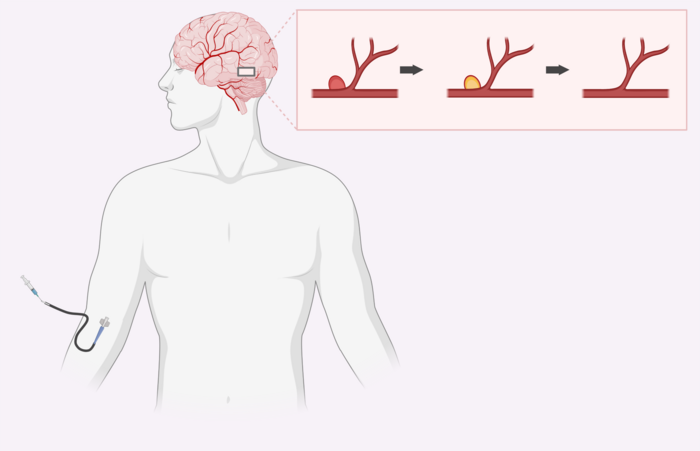 Treating Aneurysms with Injectable Toothpaste-Like Biomaterials