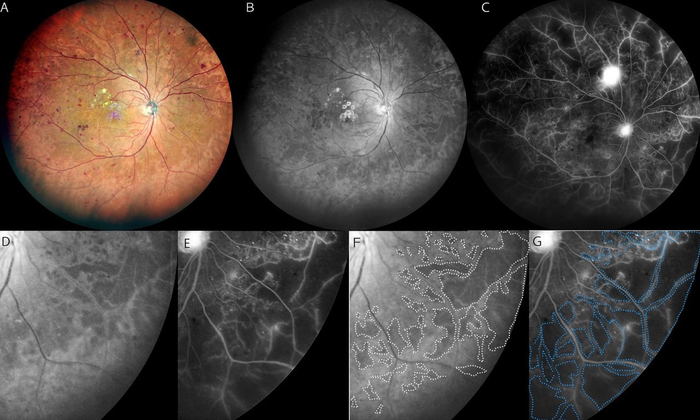 Concordance of hyporeflective areas in the blue widefield scanning laser ophthalmoscope images and non perfused areas in fluorescein angiography image in proliferative DR (PDR)