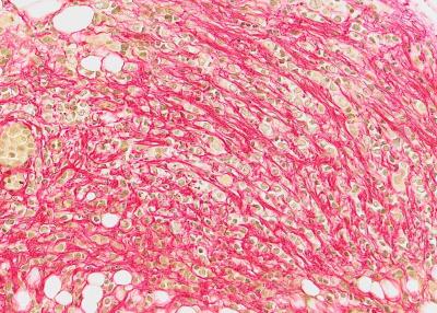 Invasive Lobular Carcinoma Intraductal Xenograft Tissue Section Stained for Fibrillar Collagen.