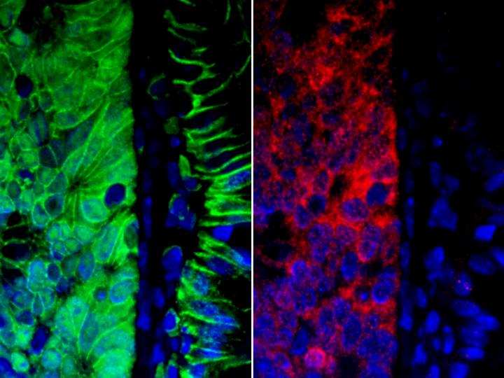 Gene Expression in Colon Cancer