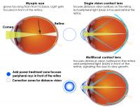 How multifocal lenses control myopia