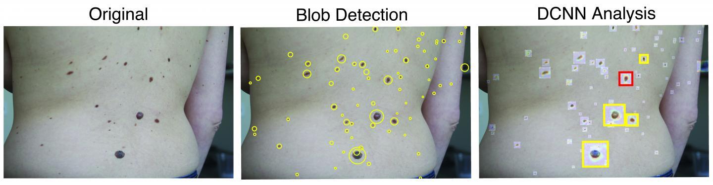 Neural Network Could Help Clinicians Look for "Ugly Duckling" Pre-Cancerous Skin Lesions (2 of 5)