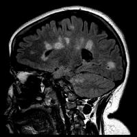 Multiple Sclerosis Scarring of Brain